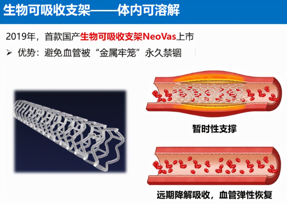 可降解支架最新动态，创新变革引领未来之路，自信与成就感并行